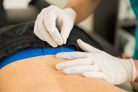 Who Can Perform Dry Needling?