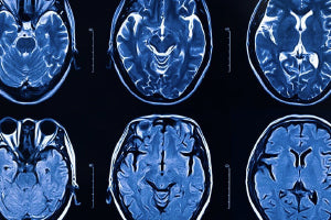 Becoming A Certified Stroke Rehabilitation Specialist – HomeCEU